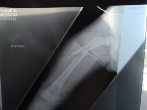 X-ray after the leg is immobilized